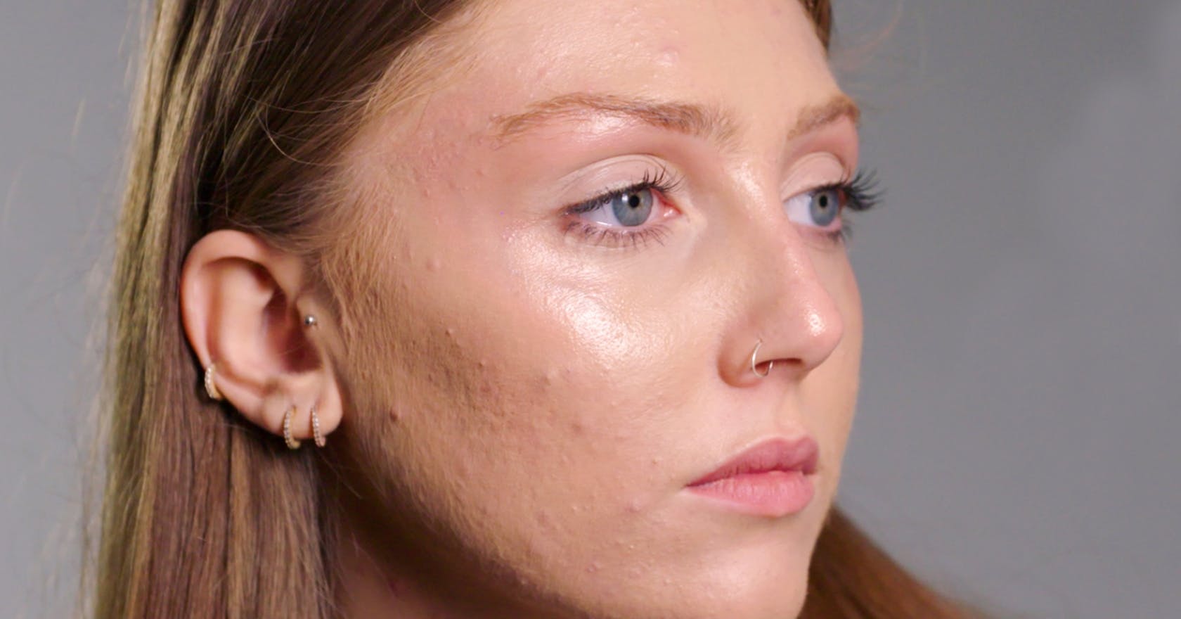 Acne needs to be normalised, says skin positivy campaigner