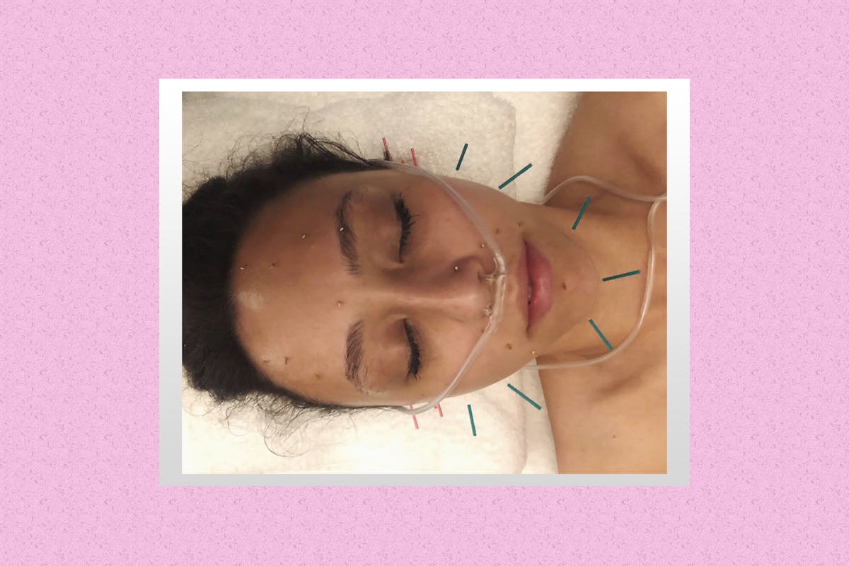 cosmetic-acupuncture-facial-shannon-peter