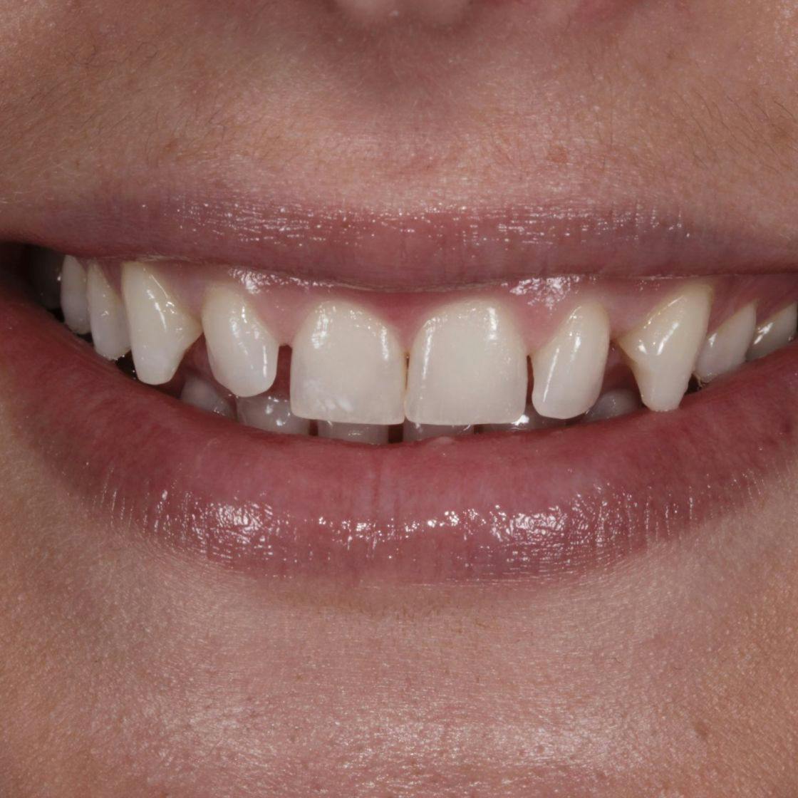 Woman's smile and teeth before composite bonding treatment