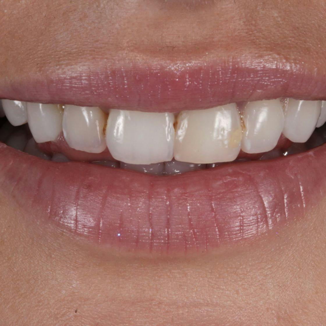 Woman's smile and teeth before composite bonding treatment