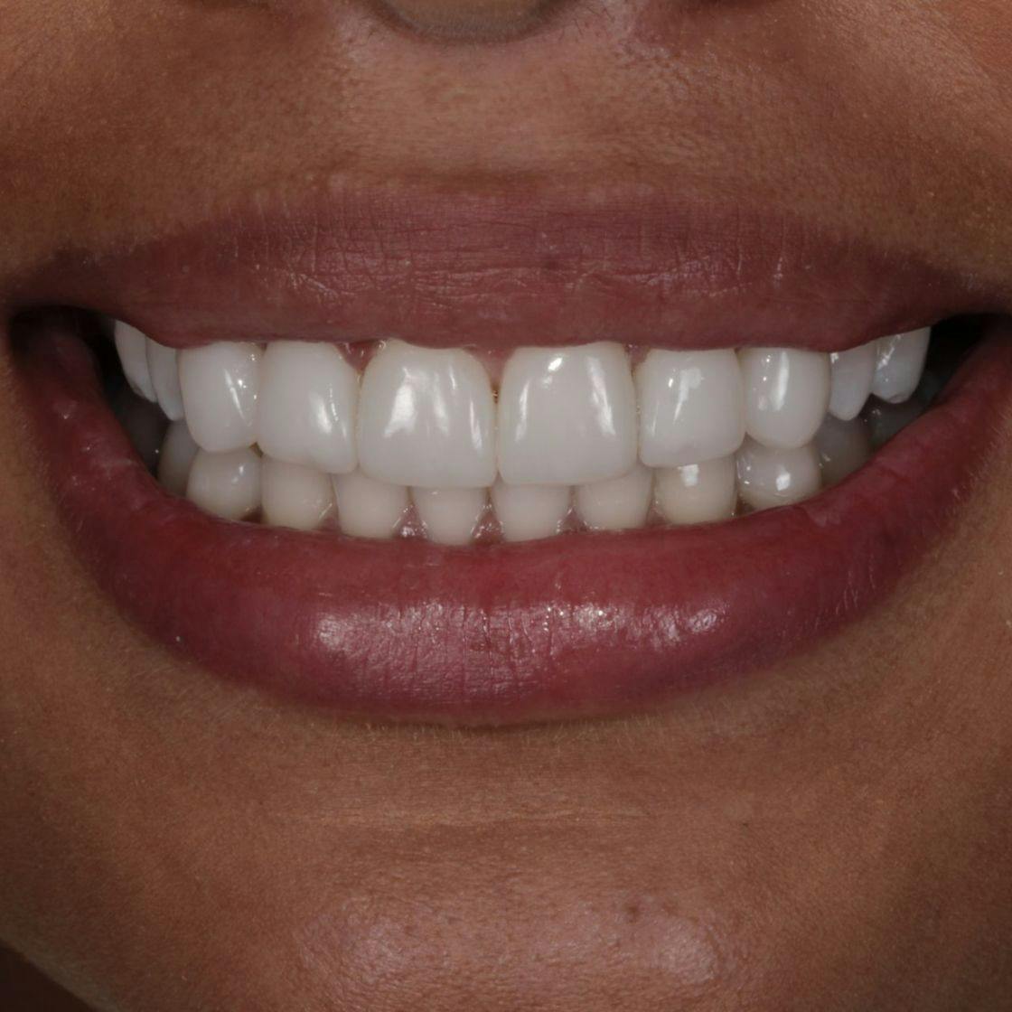 Woman's smile and teeth after composite bonding treatment